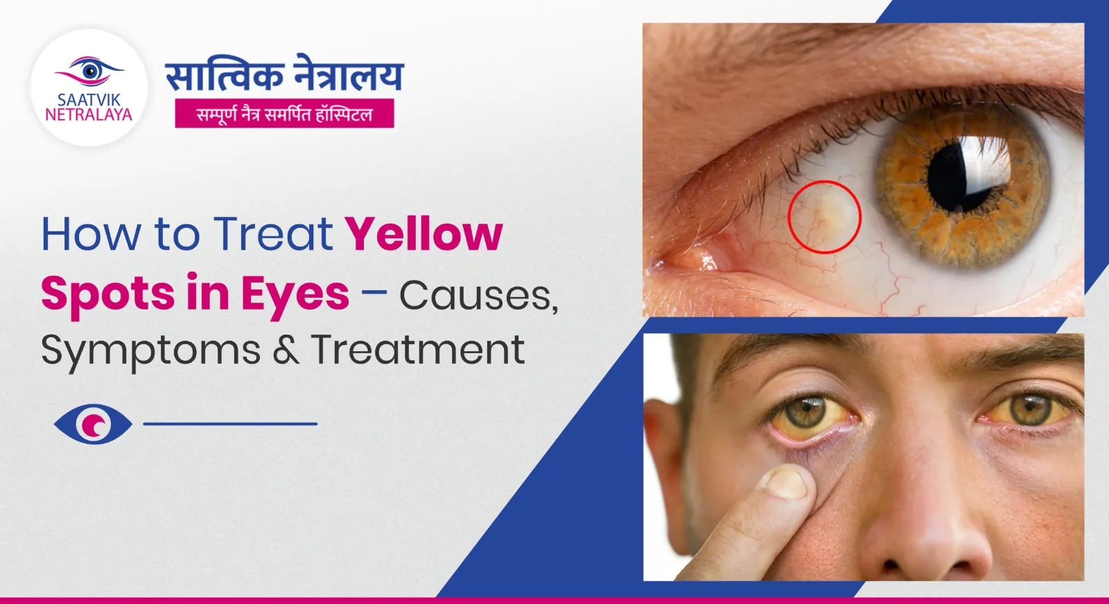 How to Treat Yellow Spots in Eyes - Causes, Symptoms & Treatment in Jaipur