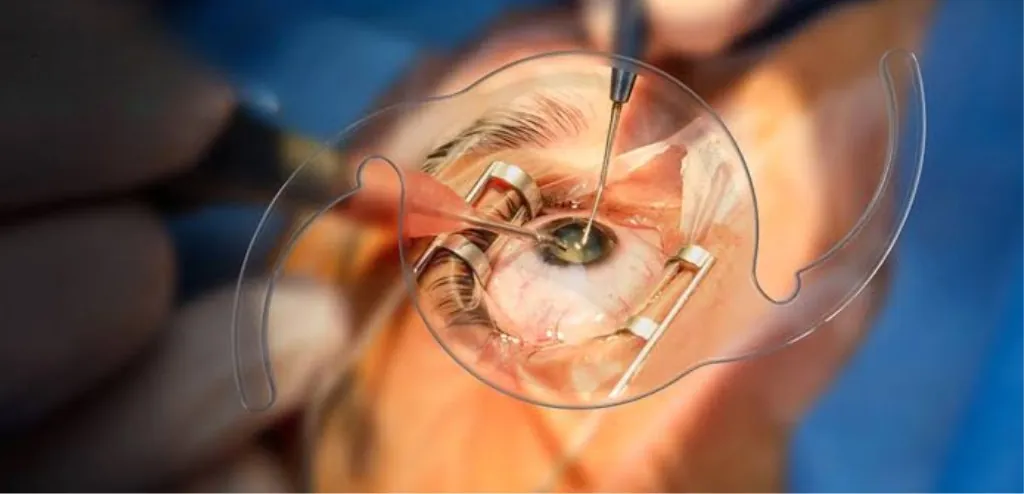 Cataract eye surgery in Jaipur at Saatvik Netralaya